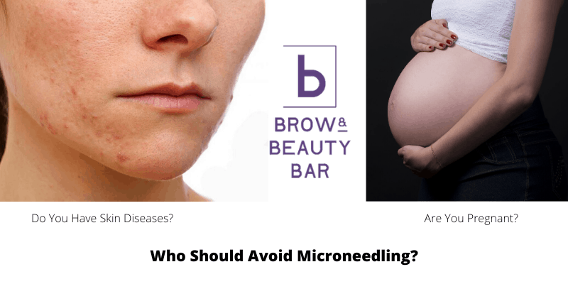 Who Should Avoid Microneedling