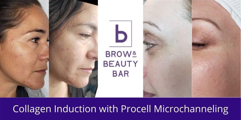 Collagen Induction with Procell Microchanneling