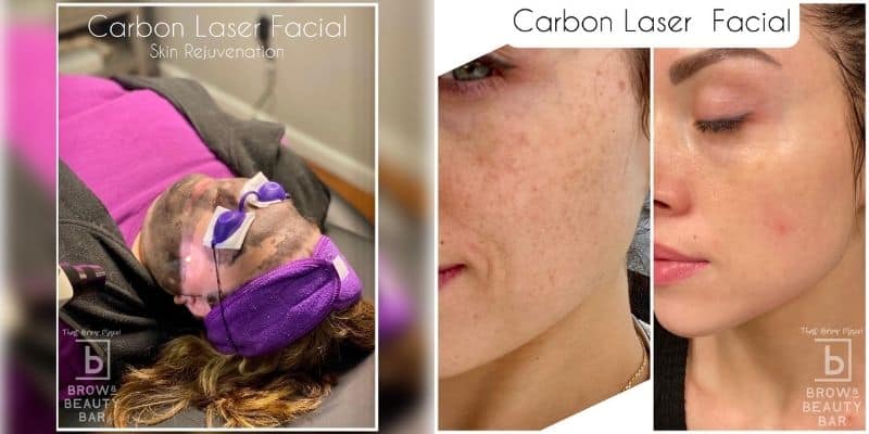 Carbon Laser Facial - Cost, Aftercare, Benefits | Brow & Beauty
